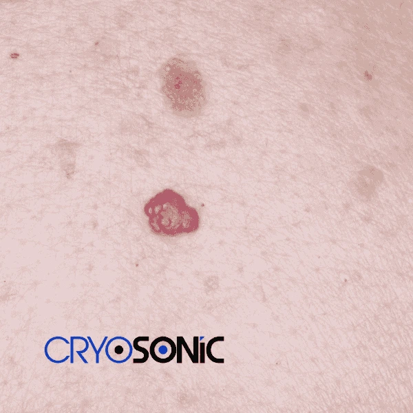 Looking for pain free cherry angioma removal treatment Croydon? Call our team today! Croydon