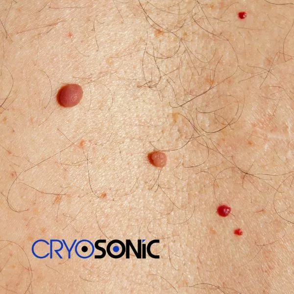 get cherry angioma removal treatment today! Croydon