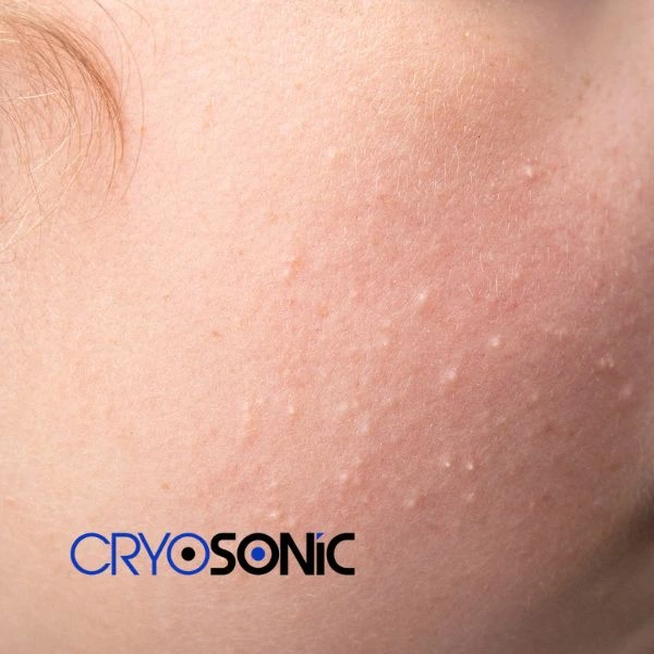 Are you looking for milia removal treatment? Contact our team today Croydon