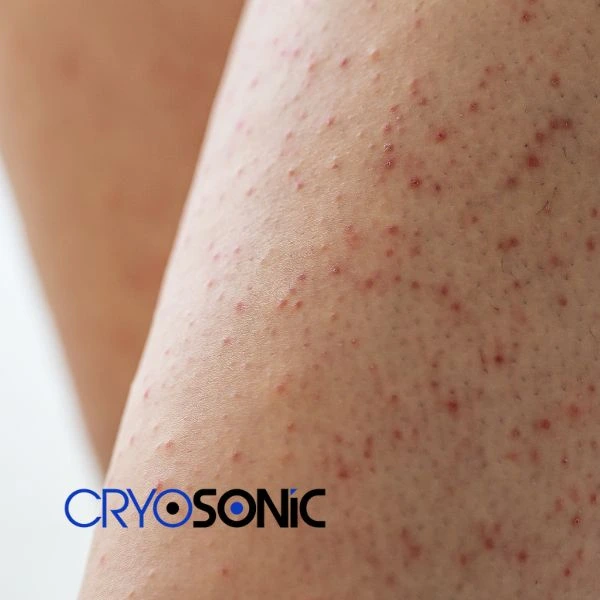 Looking for Seborrhoeic Keratosis removal Croydon treatment? Call our consultants today in Croydon