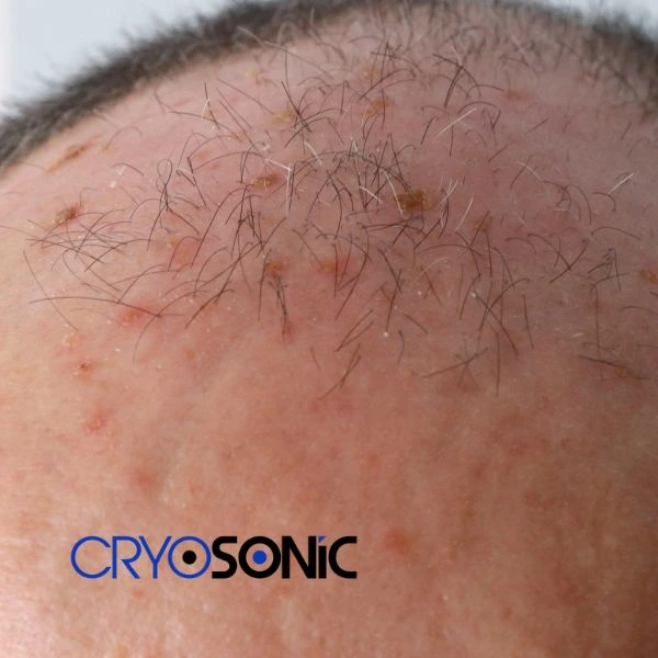 Access Seborrhoeic Keratosis removal from the comfort of your own home! Call us today in Croydon