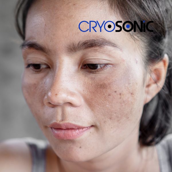Ready to start age spots removal? Contact our team today in Croydon