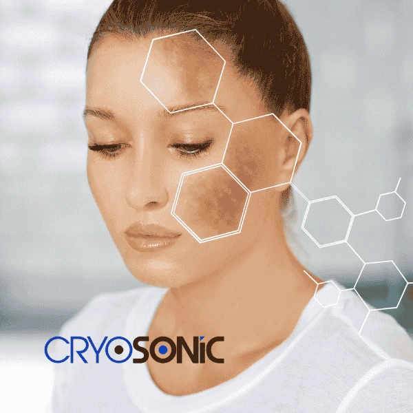 Are you looking for age spot removal treatment? Contact Cryosonic today in Croydon