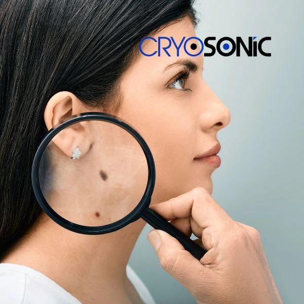 Do you want to learn more about benign moles removal treatment? Call our team today Croydon