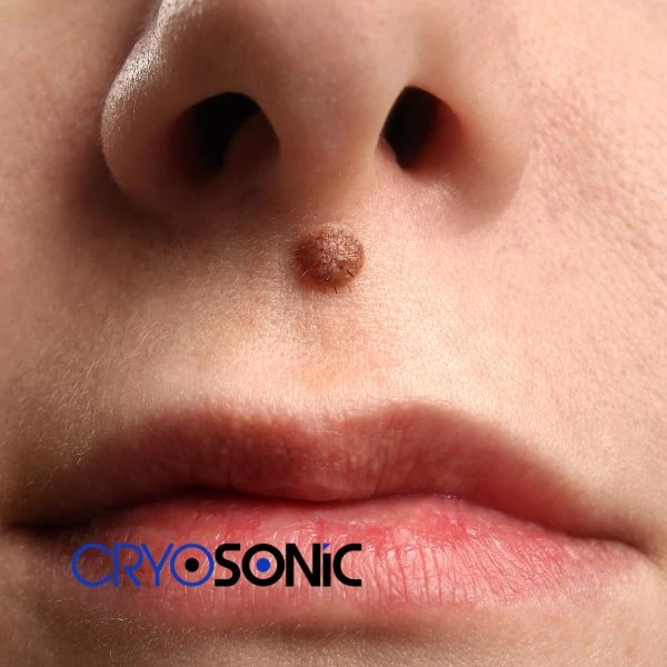 Start your benign moles removal treatment today Croydon