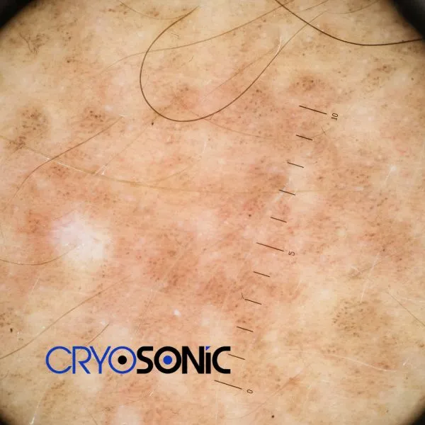 Speak to our team today about sun damaged skin treatment today in Croydon