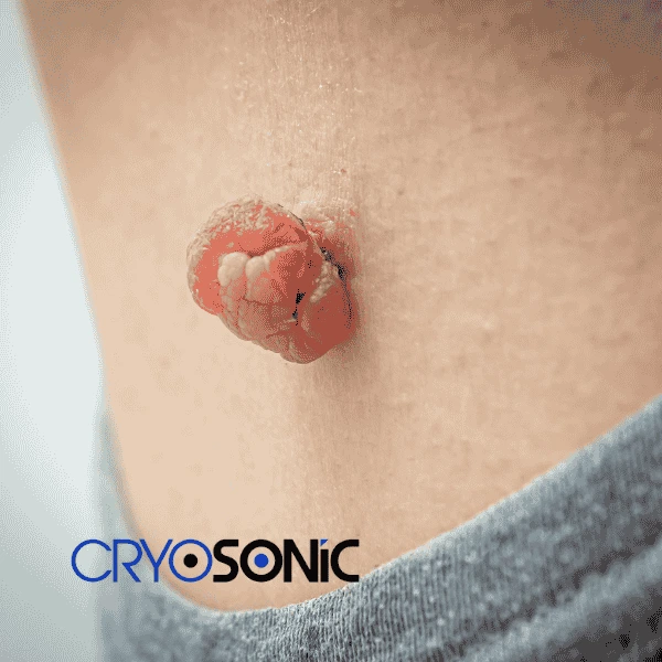 Book your skin tags removal Croydon from comfort of your own home! Croydon