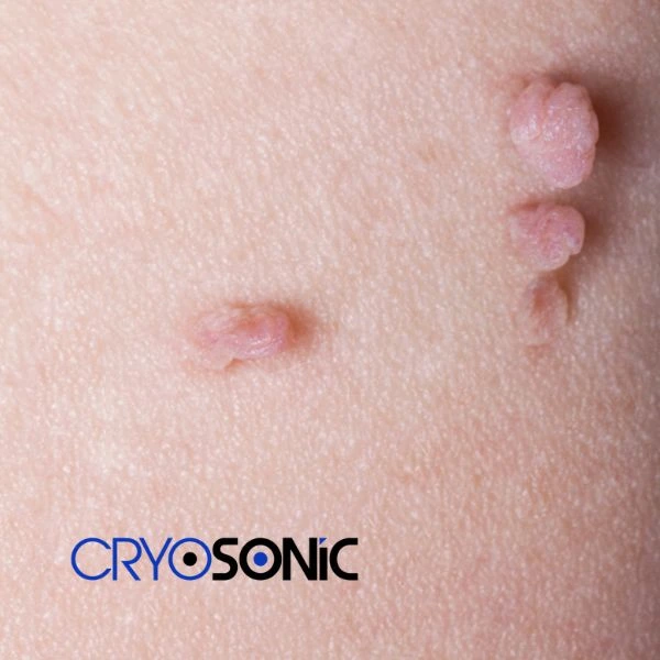 Are you looking for fast effect skin tag removal Croydon? Book in NOW! Croydon