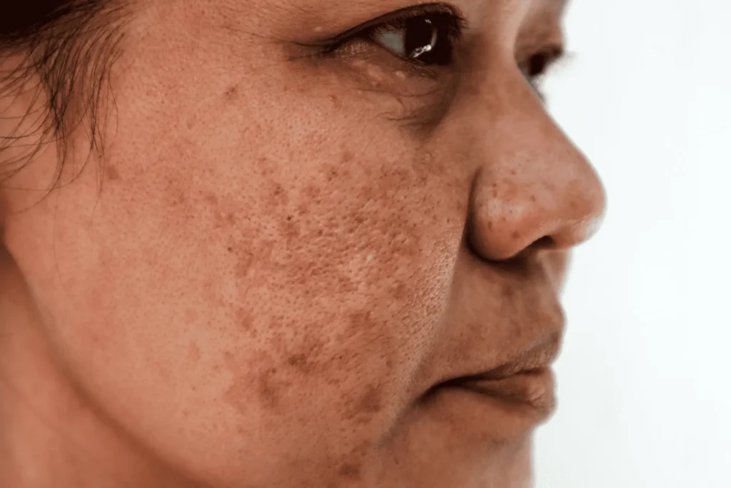 Cryosonic Repair Sun-Damaged Skin Croydon Croydon