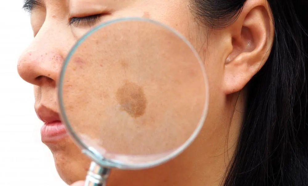 How Seborrheic Keratosis Croydon appears on the skin Croydon