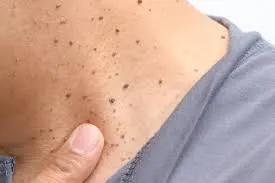 Seborrheic Keratosis: Understanding Skin Changes and CryoPen Treatment Options Croydon