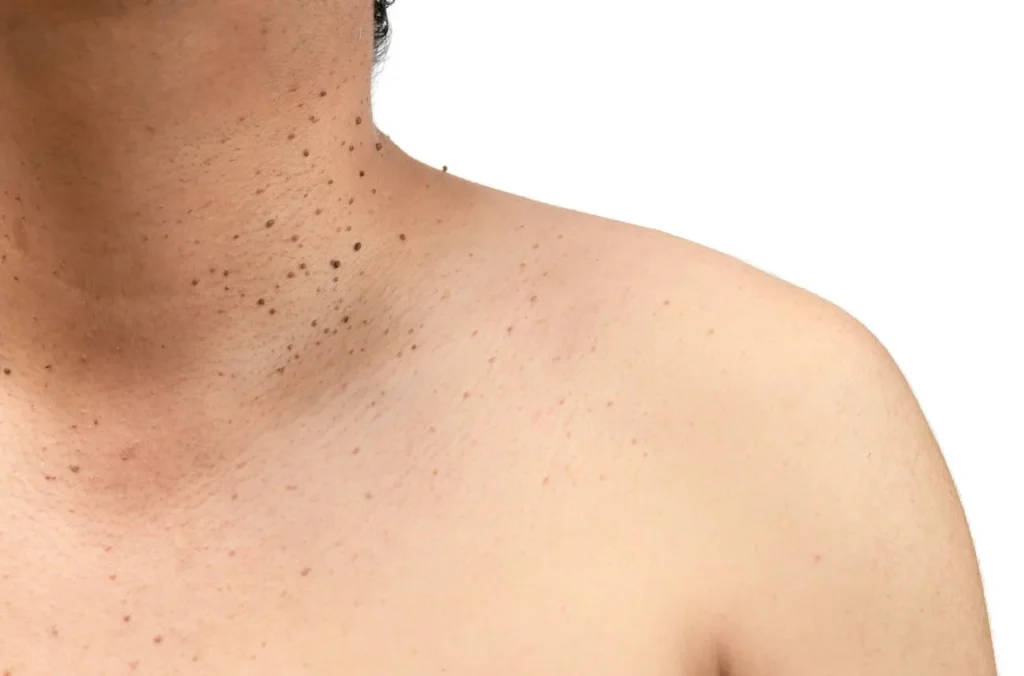 How to Maintain Healthy Skin After Treatment Croydon? Croydon