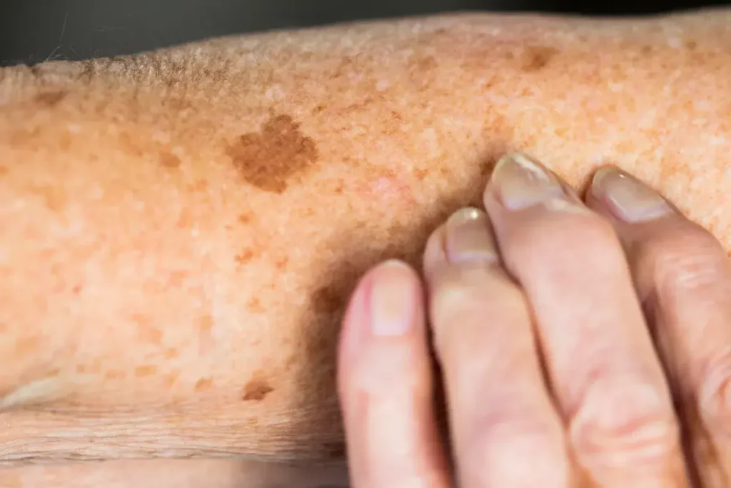 Why Is Early Treatment of Sun Damage Important Croydon? Croydon