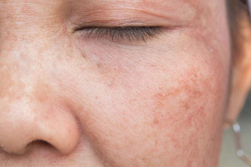 UV rays affecting skin cells, showing sun damage and the need for Cryosonic repair treatments Croydon. Croydon