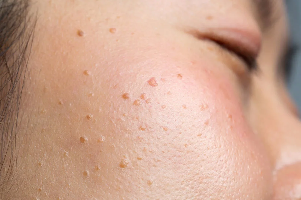Why Choose CryoPen for Seborrheic Keratosis Croydon Croydon