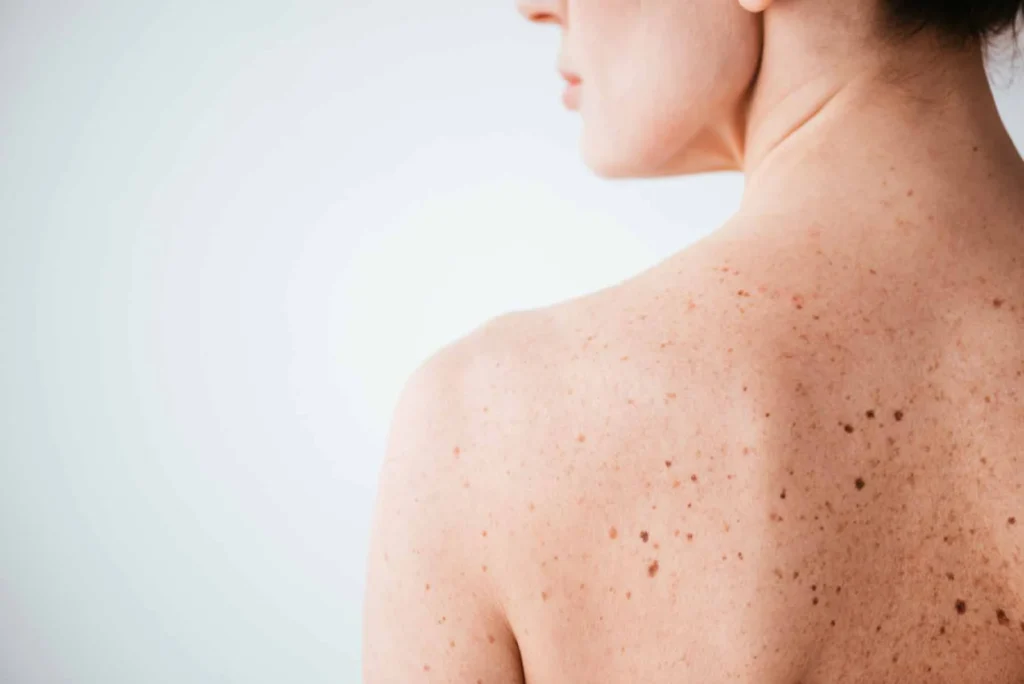 Sun Damage : Understanding UV Effects and Skin Repair Options Croydon